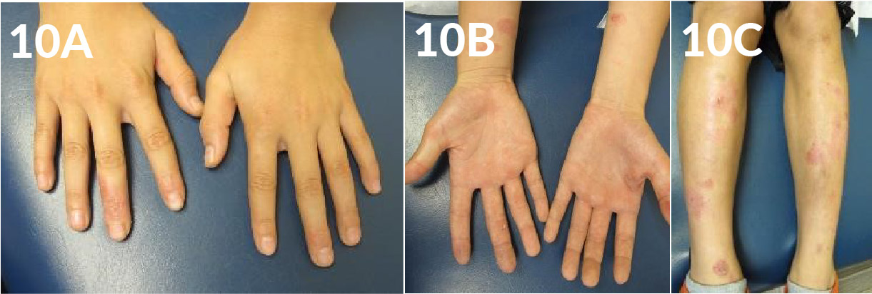 Use of Topical Crisaborole for Treating Dermatitis in a Variety of Dermatology Settings - image