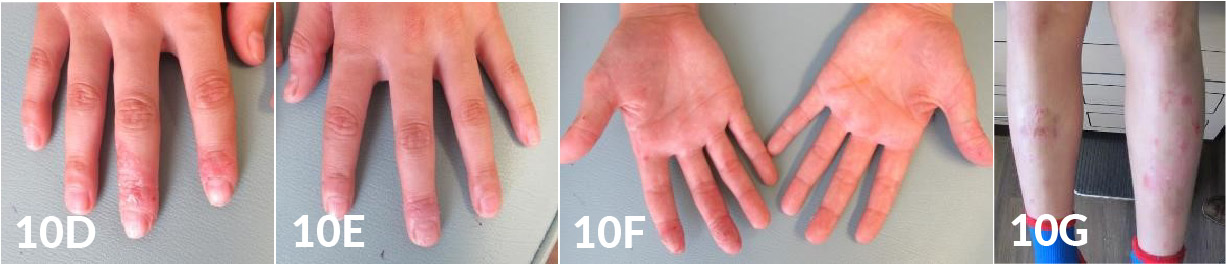 Use of Topical Crisaborole for Treating Dermatitis in a Variety of Dermatology Settings - image