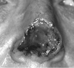 Nasal defect of the right dorsal nose, nasal tip, and ala, with extension in depth to the subcutaneous tissue and perichondrium. Note attenuated alar rim.