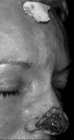 Telfa® template turned 180º and placed on the midforehead with gentian violet marking around its perimeter.