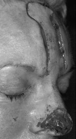 Forehead flap incised and undermined.