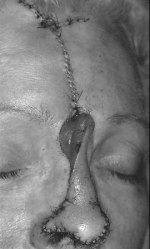 Forehead flap having been rotated 180º is sutured into the nasal defect and the donor forehead defect is sutured. Note between the eyebrows, the open portion of the pedicle, which will be left to heal by second intention.