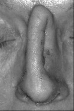 Healed pedicle flap prior to insetting at 5 weeks.