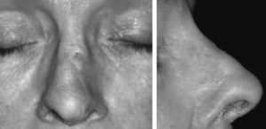Healed forehead flap 7 years after surgery. Telangiectasia can be removed by laser and small nasal bump by excision. A) Frontal view B) Side view.