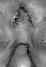 Inset and sutured proximal and distal portions of pedicle flap. Note that the inverted V-shaped flap, after the proximal pedicle flap, is inset, which allows for widening of the inter-eyebrow distance.