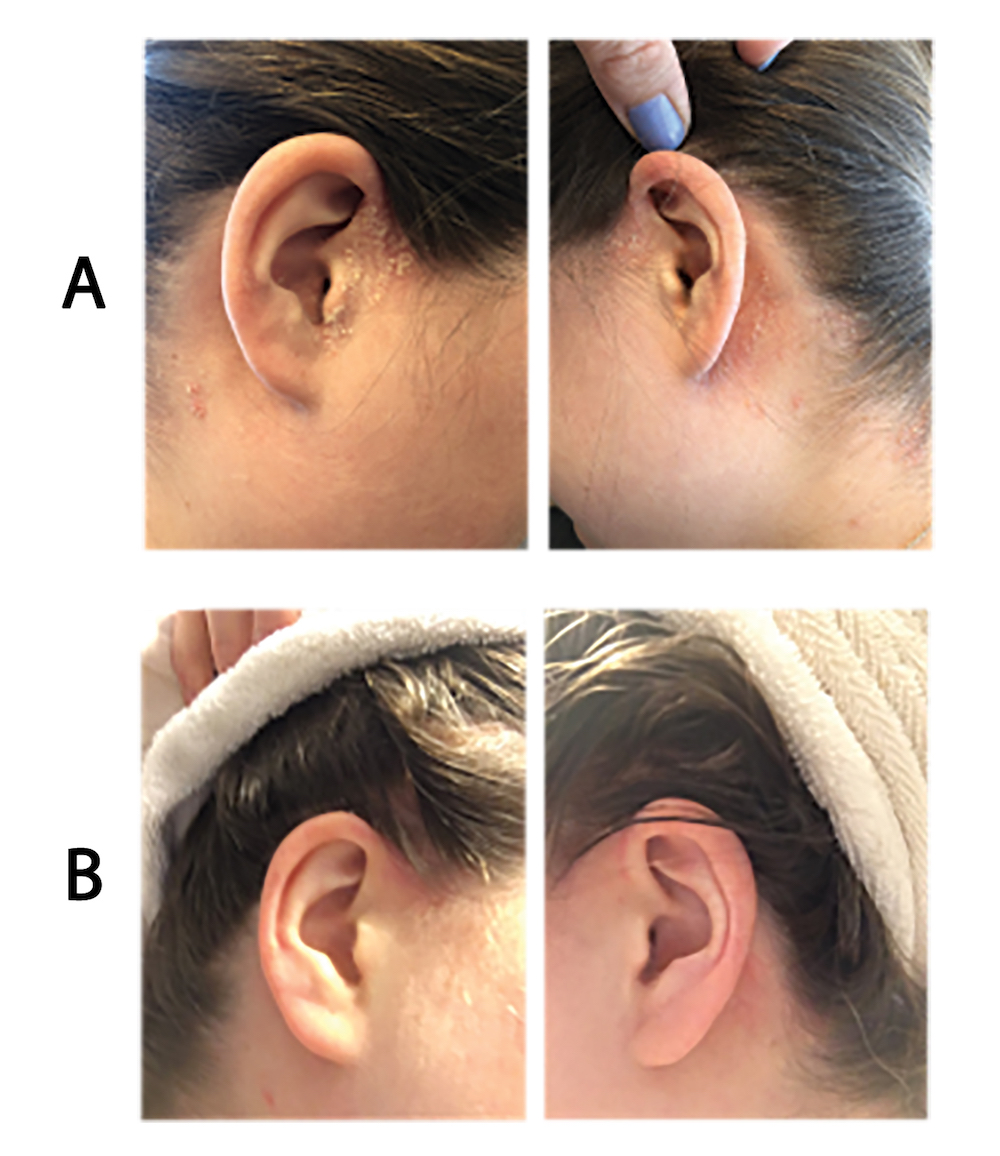 Psoriasis on the ears and scalp before and after treatment with calcipotriol-betamethasone aerosol foam