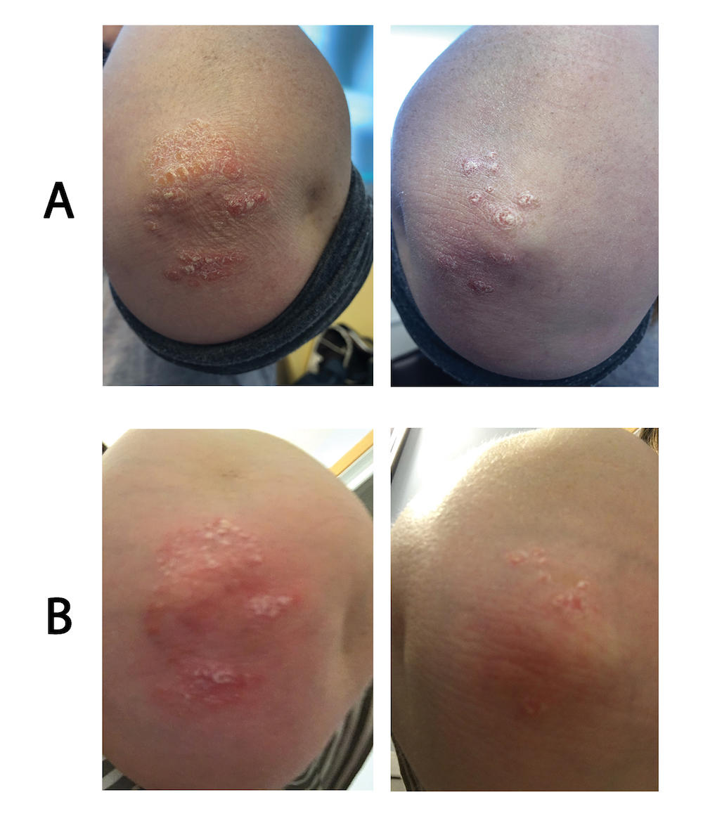 Psoriasis on the elbows before and after treatment with calcipotriol-betamethasone aerosol foam