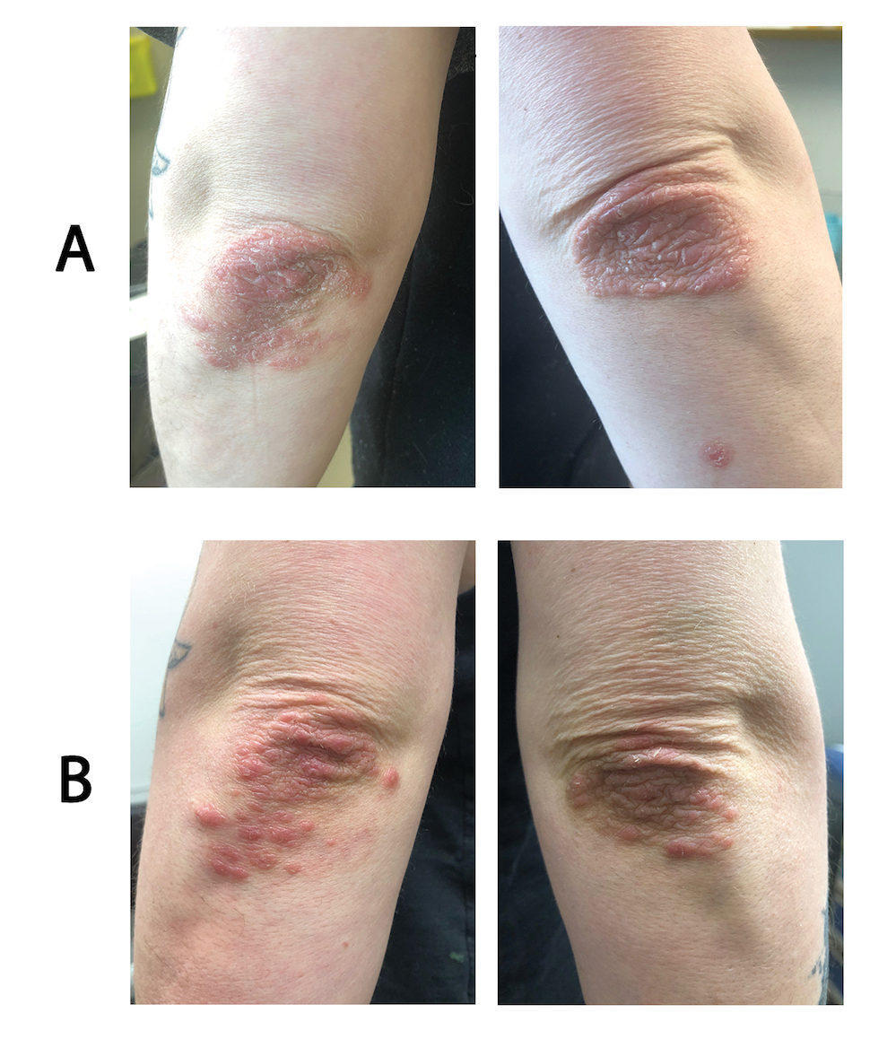 Psoriasis on the elbows before and after treatment with calcipotriol-betamethasone aerosol foam