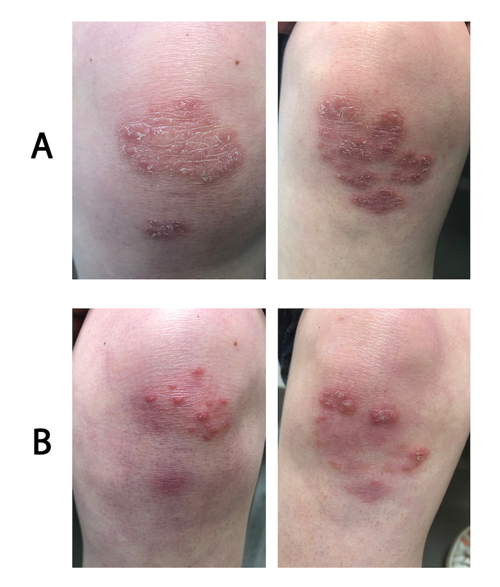 Psoriasis on the knees before and after treatment with calcipotriol-betamethasone aerosol foam