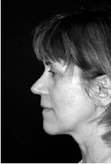Reduction of Face and Neck Laxity With Anchored, Barbed Polypropylene Sutures (Contour Threads™) - image