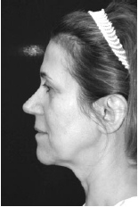 Reduction of Face and Neck Laxity With Anchored, Barbed Polypropylene Sutures (Contour Threads™) - image