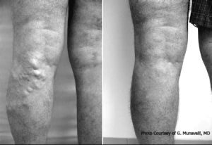 Clinical improvement 6 weeks after treatment of the LSV with endovenous ablation