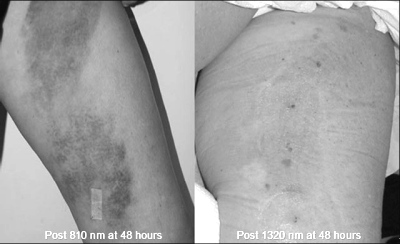 Comparison of Greater Saphenous Vein treatment with 810nm vs. 1320nm 48 hours posttreatment.