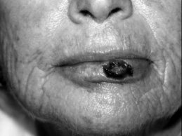 Novel Flaps for Lip Reconstruction - image