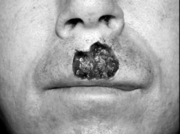 Novel Flaps for Lip Reconstruction - image