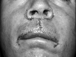 Novel Flaps for Lip Reconstruction - image