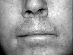 Novel Flaps for Lip Reconstruction - image