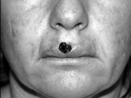 Novel Flaps for Lip Reconstruction - image