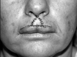 Novel Flaps for Lip Reconstruction - image