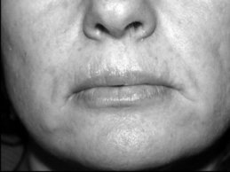 Novel Flaps for Lip Reconstruction - image