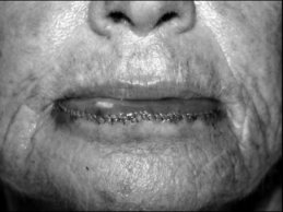 Novel Flaps for Lip Reconstruction - image