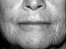 Novel Flaps for Lip Reconstruction - image
