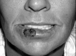 Novel Flaps for Lip Reconstruction - image