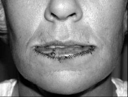 Novel Flaps for Lip Reconstruction - image