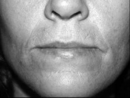 Novel Flaps for Lip Reconstruction - image