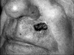 Novel Flaps for Lip Reconstruction - image
