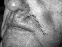 Novel Flaps for Lip Reconstruction - image