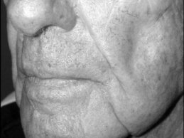 Novel Flaps for Lip Reconstruction - image