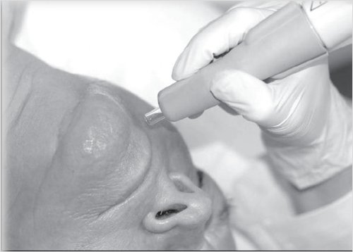 Plasma treatment at low energy