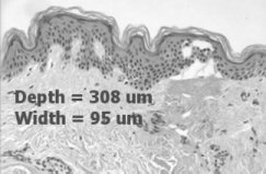 Depth coagulation at 8mJ.