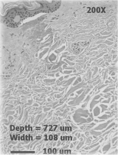 Depth coagulation at 20mJ.