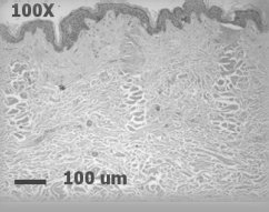 Depth coagulation at 20mJ.