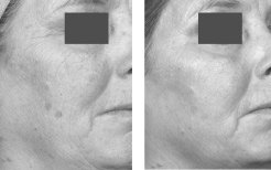 Treatment to improve pigmentation and rhytides using the Fraxel® Laser at baseline and after 4 treatments at 8mJ, 2,500MTZ/cm<sup>2</sup>.
