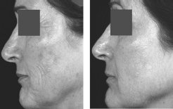 Treatment to improve pigmentation and rhytides using the Fraxel<sup>®</sup> Laser at baseline and after 4 treatments.