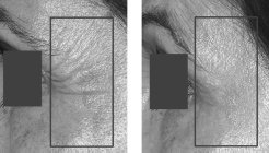 Treatment to improve pigmentation and rhytides using the Fraxel® Laser at baseline and after 4 treatments.