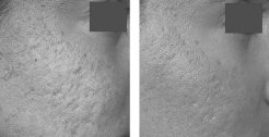Treatment of acne scarring using the Fraxel® Laser at baseline and 1 month after 5 treatments q2wk, 15mJ, 1,500MTZ/cm<sup>2</sup>.