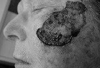 A 45cm<sup>2</sup> defect on the left cheek following Mohs micrographic surgery for a Lentigo Maligna