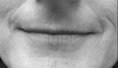 Rejuvenation of the Lip with Injectables - image
