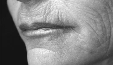 Rejuvenation of the Lip with Injectables - image