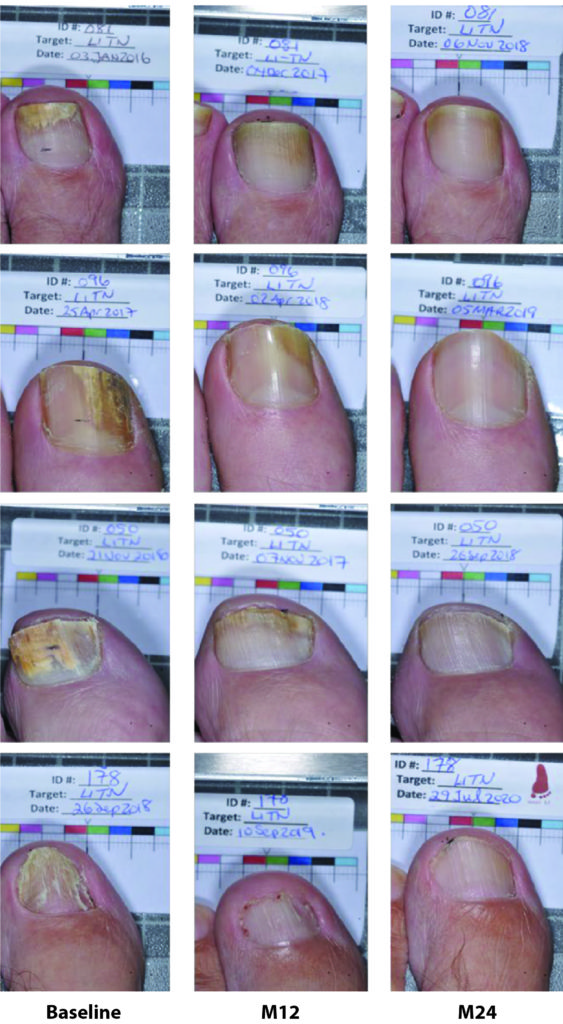 Set of photos from 4 patients, showing the progress of toenail treatment