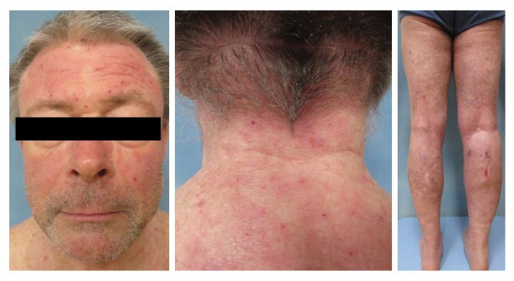 Real-World Insights from Atopic Dermatitis Patients Treated with Abrocitinib - image