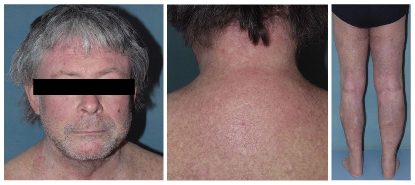 Real-World Insights from Atopic Dermatitis Patients Treated with Abrocitinib - image