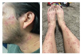Real-World Insights from Atopic Dermatitis Patients Treated with Abrocitinib - image