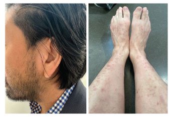 Real-World Insights from Atopic Dermatitis Patients Treated with Abrocitinib - image