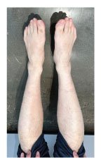 Real-World Insights from Atopic Dermatitis Patients Treated with Abrocitinib - image
