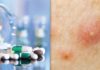 Dosing for Accutane® (Isotretinoin)
